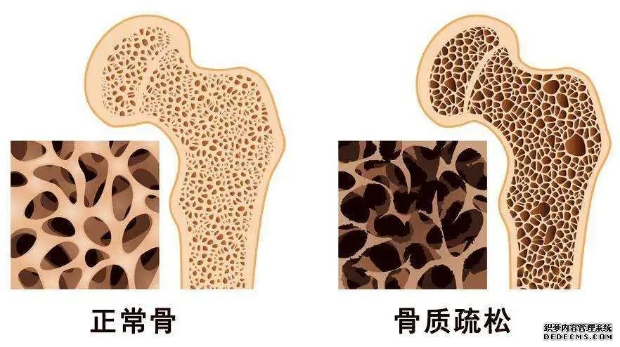 世界骨质疏松日 | 预防“骨质疏松”补钙就可以了吗？营养专家送你一份“护骨秘籍”